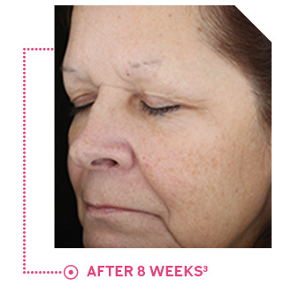 Panelist photo reflects average improvement in pigmentation after 8 weeks of use.