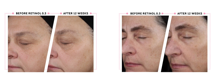 Before and after images demonstrate average visible improvement in deep lines, fine lines, blotchiness and skin tone after using Retinol 0.3 nightly for 12 weeks.