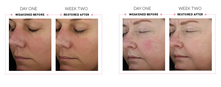 A set of before and after images showing a reduction in the appearance of skin redness from day one to week two
